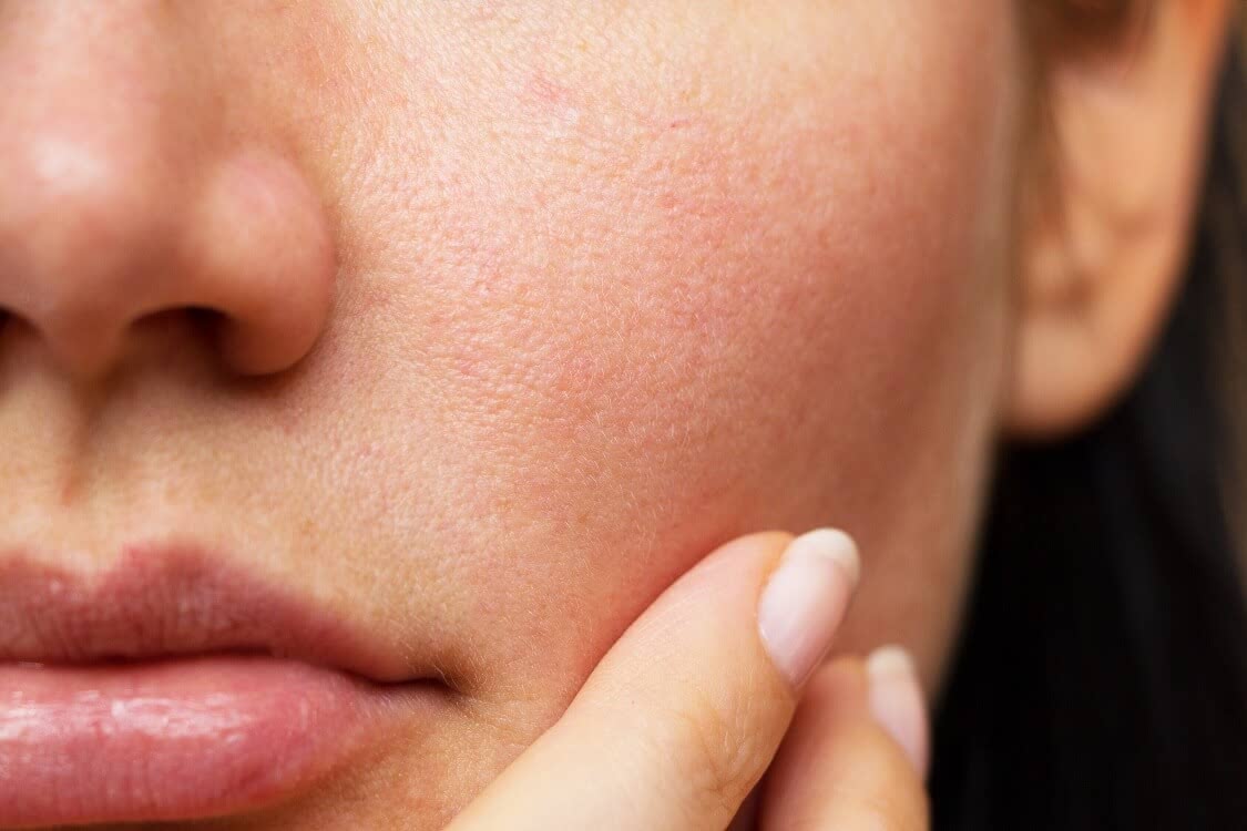 脂漏性皮膚炎とは 敏感肌の長引く皮脂トラブルの原因 正しい対策を全解説 Customlife カスタムライフ