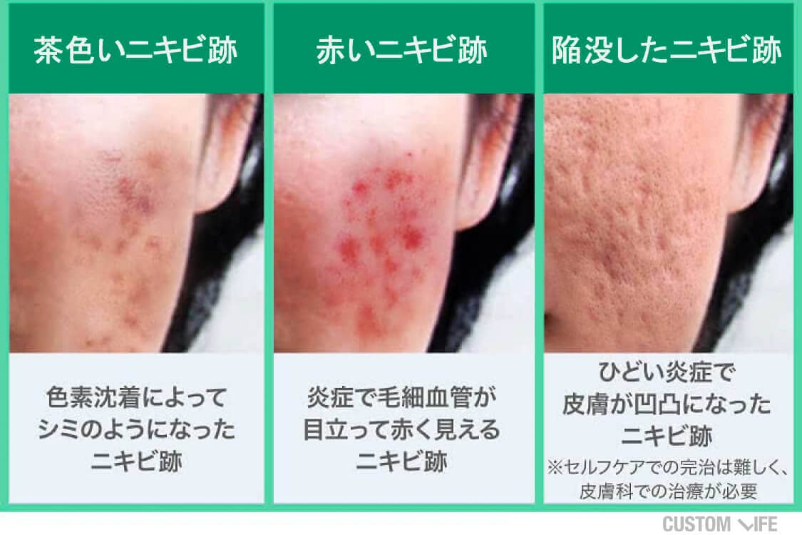 ニキビの瘢痕性注意点