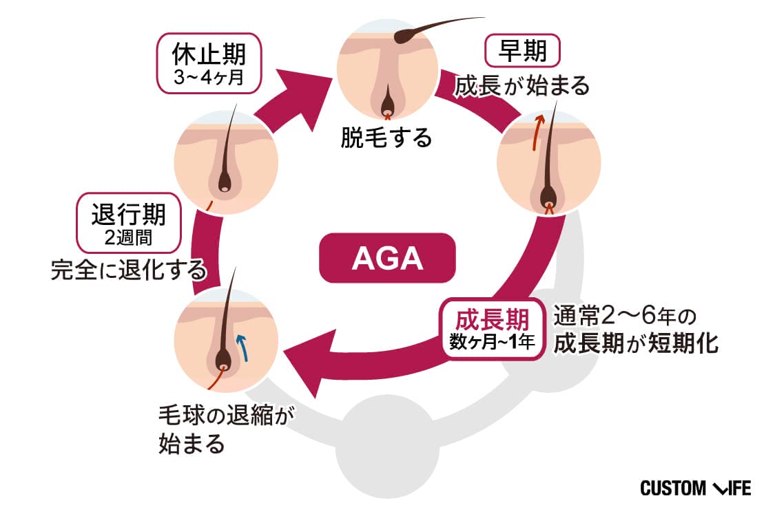 AGA治療 おすすめ