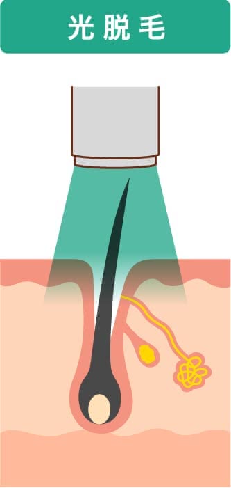 ヒゲ脱毛の費用相場は サロンやクリニックの料金を比較 効果を徹底解説 Customlife カスタムライフ