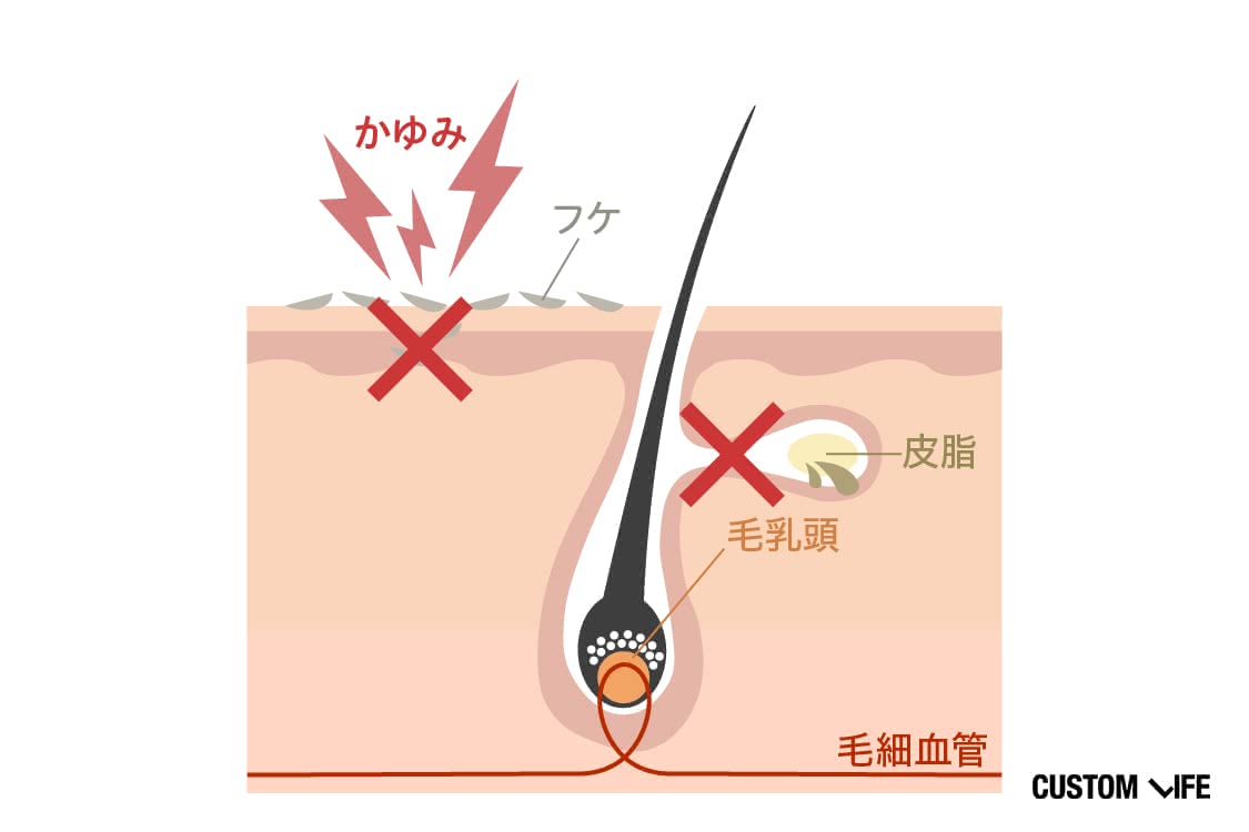 かゆみやフケなどの頭皮トラブルのイメージ画像