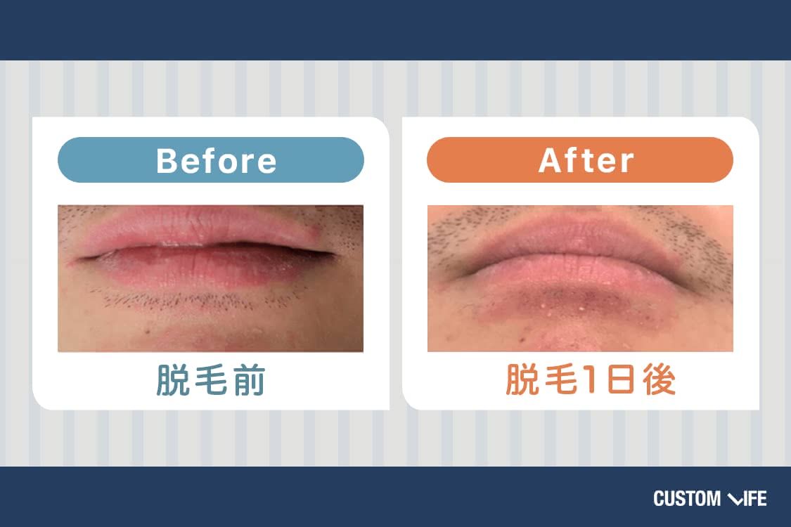 口下の脱毛のビフォーアフター。施術後はヒゲがなくなる