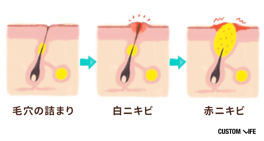 毛穴の詰まり→白ニキビ→赤ニキビ、に