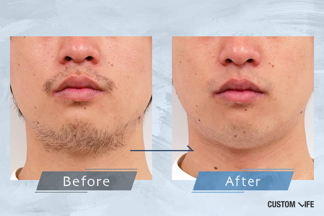 髭剃りで肌荒れする原因と対策 実際に試してカミソリ負けを防ぐ10選を検証 Customlife カスタムライフ