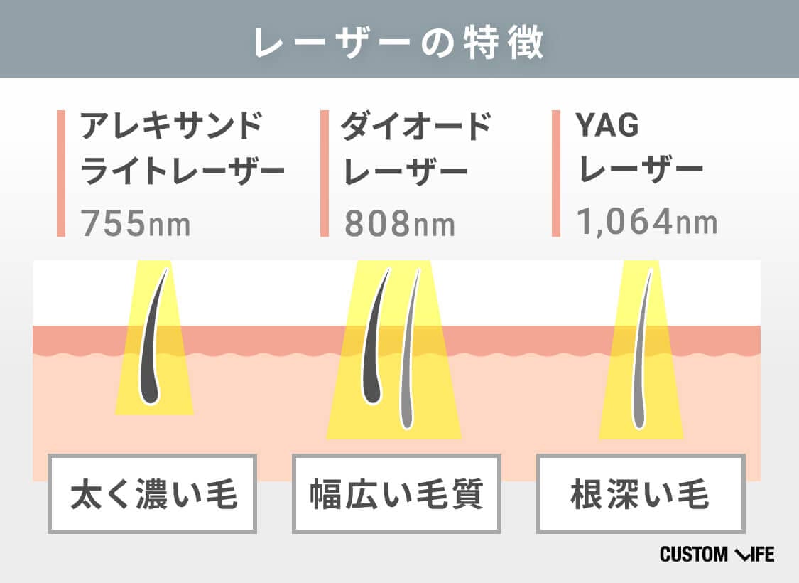 レーザーごとの特徴