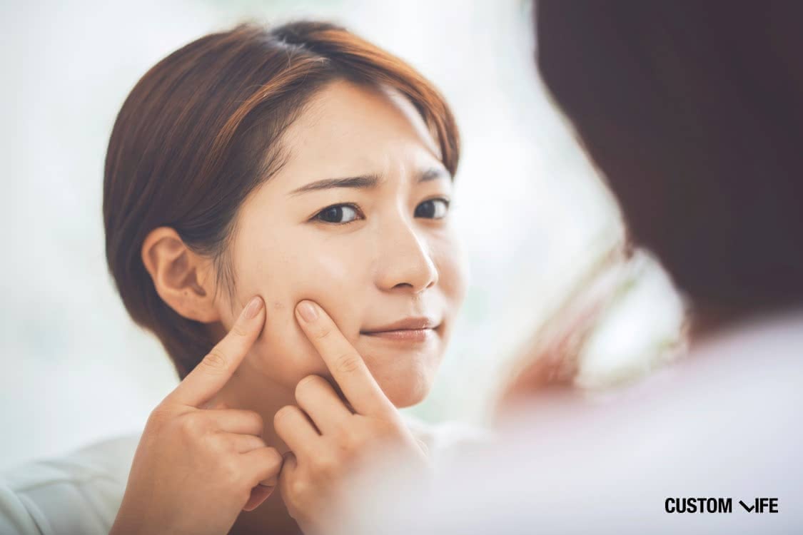 ニキビ シミ ニキビを潰すとシミになりやすい？