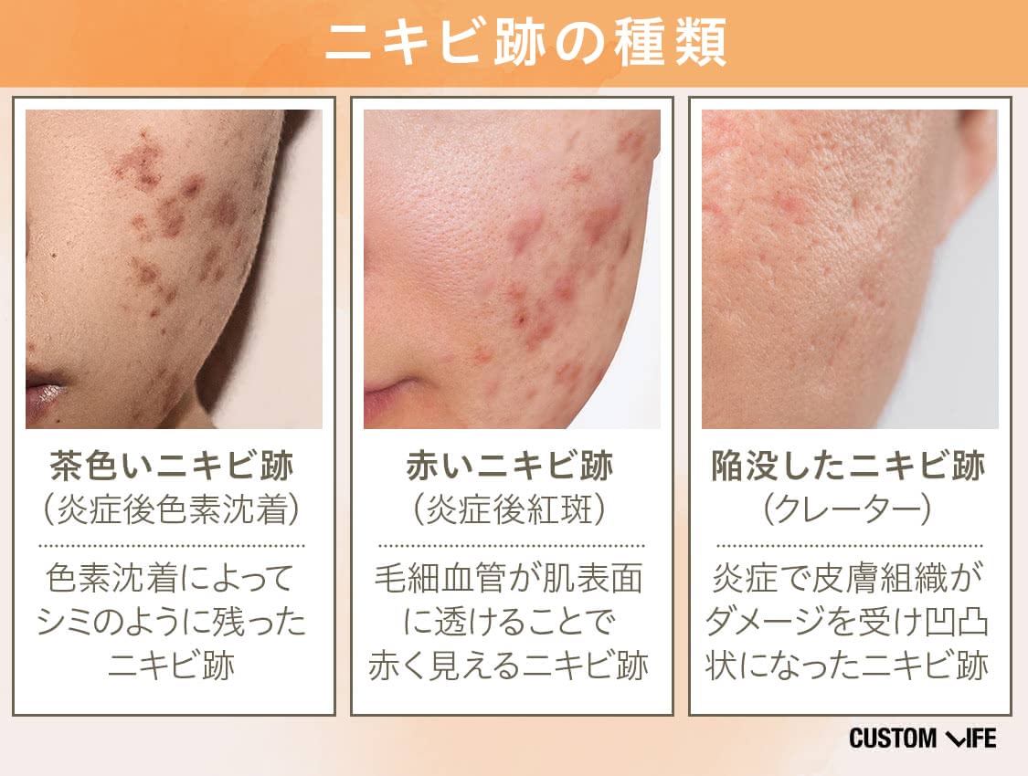 ニキビ シミ ニキビ跡の種類と特徴 炎症後色素沈着 炎症後紅斑 クレーター