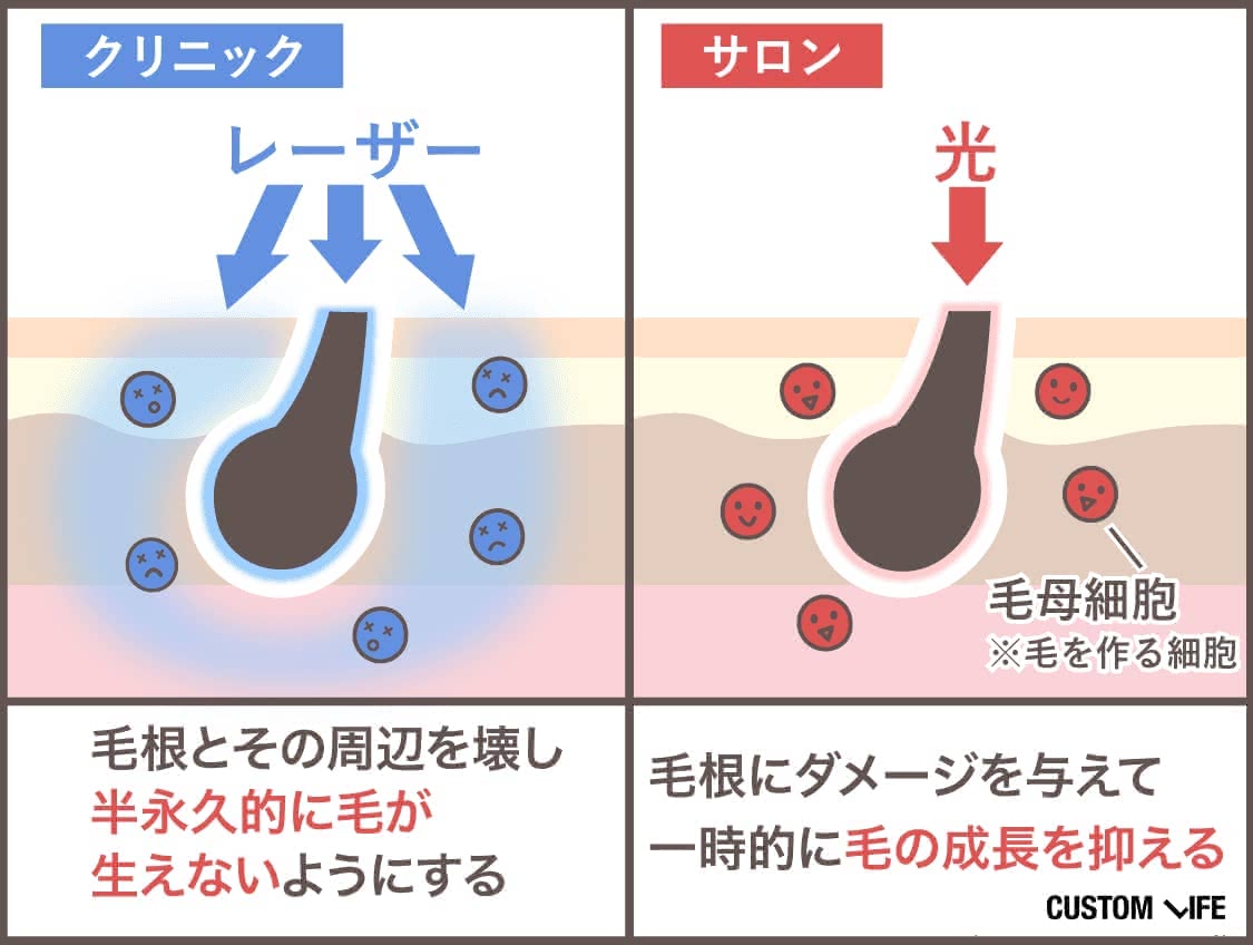 メンズ医療脱毛,都度払い