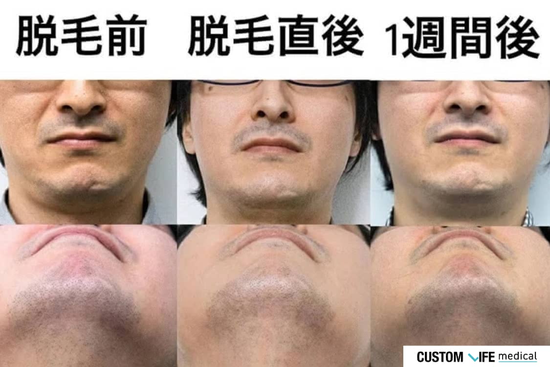 ゴリラクリニック ヒゲ脱毛 Before-After