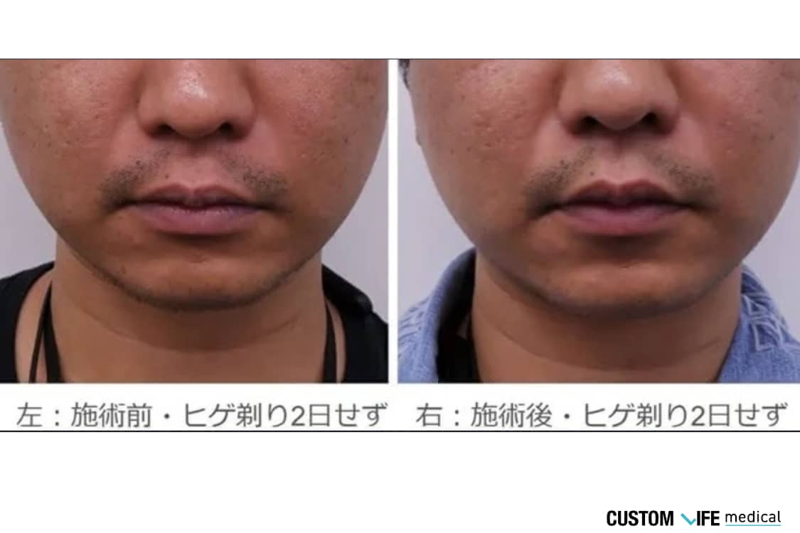 メンズクリア 脱毛 Before-After