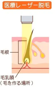 仙台 ヒゲ脱毛