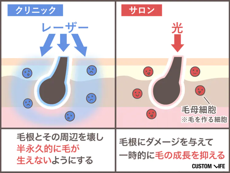 ヒゲ脱毛 沖縄 医療脱毛とサロン脱毛の違い