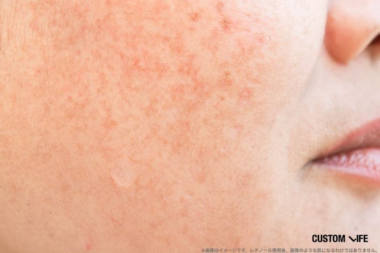 レチノール美容液のQ＆A レチノールの赤み・剥けが出る A反応 はどう対処する？